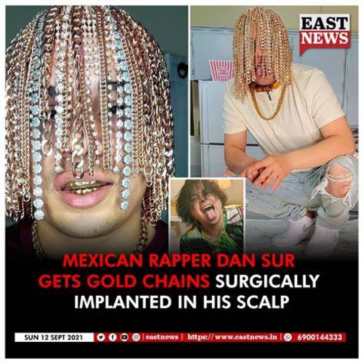 Rapper Dan Sur Gets Gold Chain Implanted Into His Head — Guardian Life